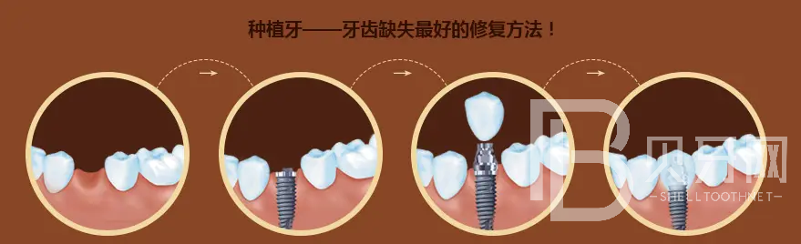 北京种植牙哪里好？北京德贝口腔怎么样？