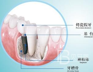 半口种植牙要种几颗?北京维恩口腔怎么样？