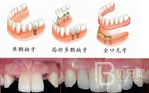 半口种植牙一般需要几个阶段？北京德贝口腔种植牙正规吗？