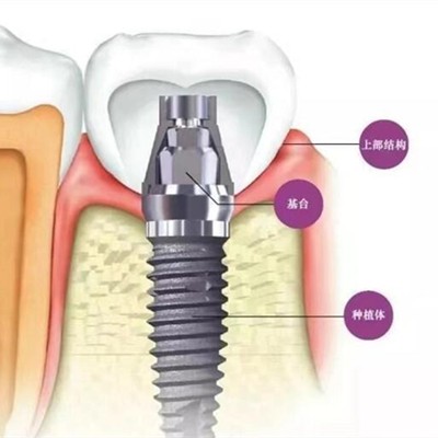 贵阳种植一颗假牙多少钱！云岩美尔迪口腔诊所种植牙价格表，瑞典诺贝尔Active种植牙：13232元起/颗！